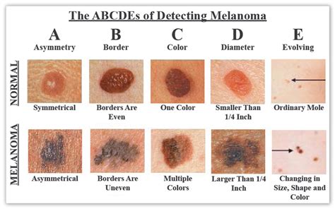 Anyajegyek összehasonlítása a melanoma gyanú jelei szerint