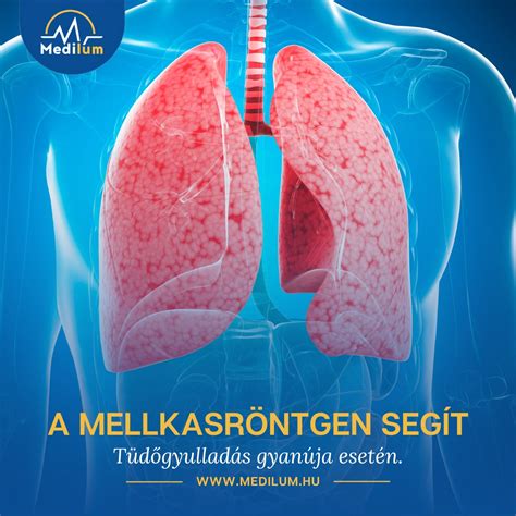 Mellkasröntgen felvétel tüdőgyulladás esetén
