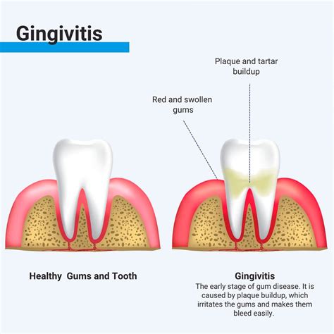 Terhességi gingivitis illusztrációja