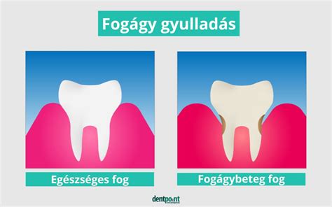 A fogágy anatómiája