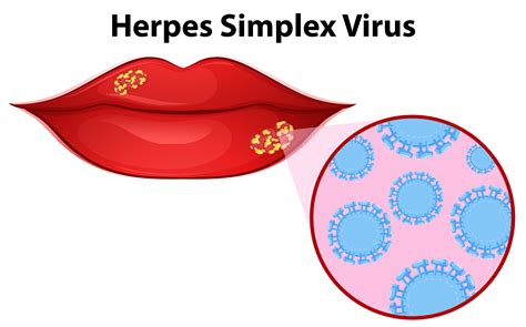 Herpes simplex vírus szemléltetése