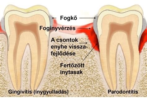Az ínygyulladás és parodontitis tünetei