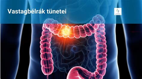 A vastagbélrák stádiumait bemutató táblázat