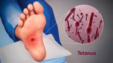Tetanusz baktérium és spórái