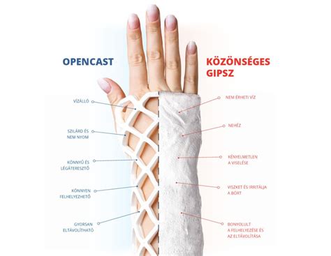 OPENCAST rögzítés különböző végtagtörések esetén