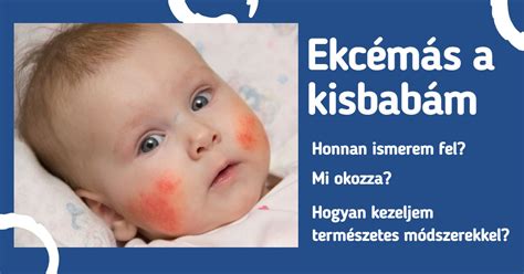 Baba bőrének tünetei ekcéma esetén