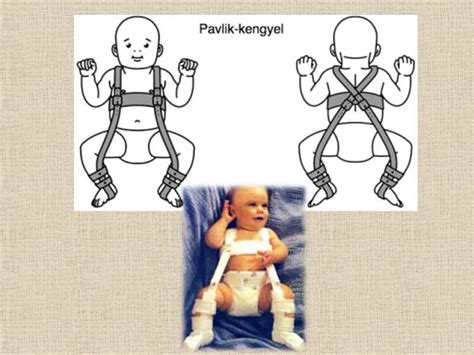 Pavlik-kengyel használata csípőficam kezelésére