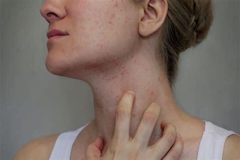 Allergiás reakciók a bőrön és emésztőrendszerben