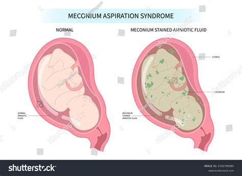A meconium (magzatszurok) kinézete