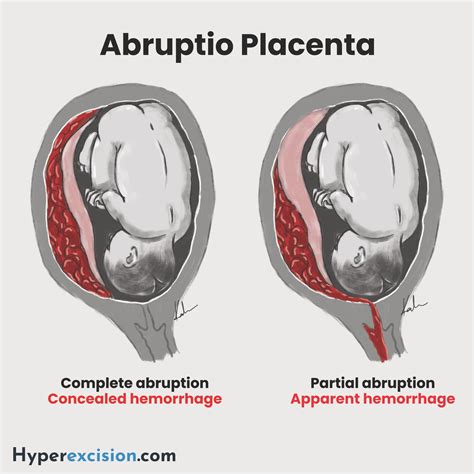 A méhlepény idő előtti leválása (abruptio placenta)