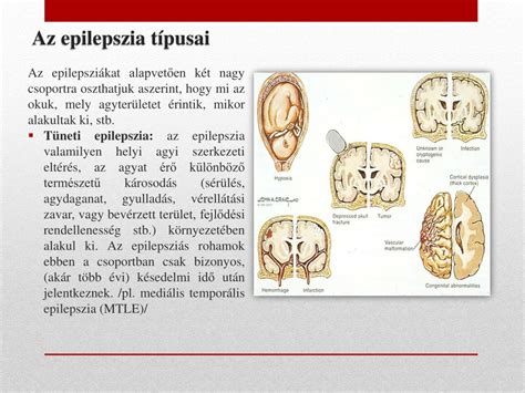 A különböző epilepszia szindrómák életkori megjelenése