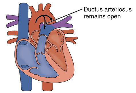 A ductus arteriosus záródása és az ibuprofén hatása