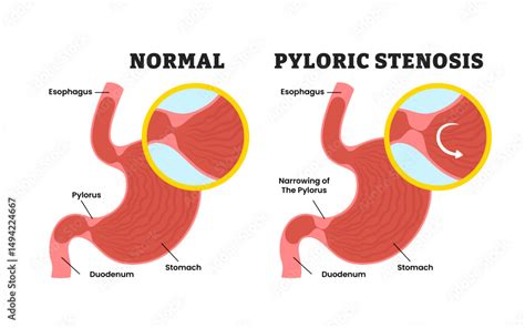 Pylorus stenosis tünetei