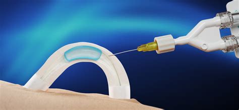 Fogamzásgátló implantátum a felkaron